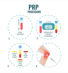 Graphic illustration of the PRP procedure